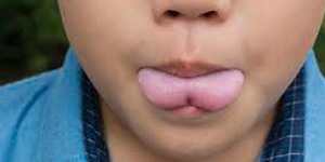 Tongue Tie Clinic